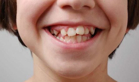Pourquoi rêver de dents tordues?