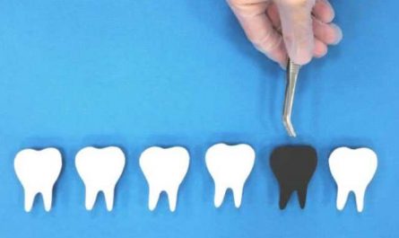 Rêver de perdre des dents noires
