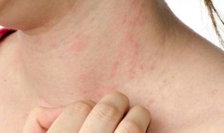 Pourquoi rêver d'urticaire ?