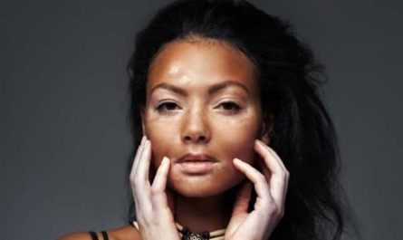 Pourquoi rêver de vitiligo ?
