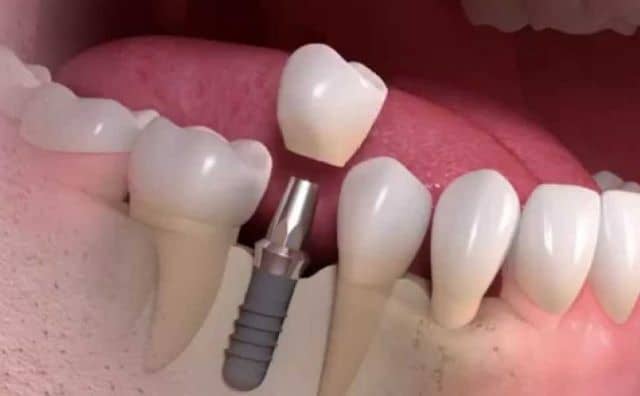 Pourquoi rêver de vis dans la bouche ?